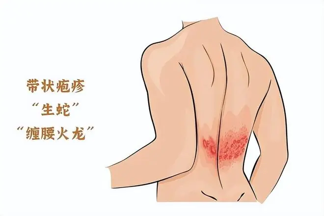 人不会无缘无故患带状疱疹!研究发现:得带状疱疹,多半有4共性